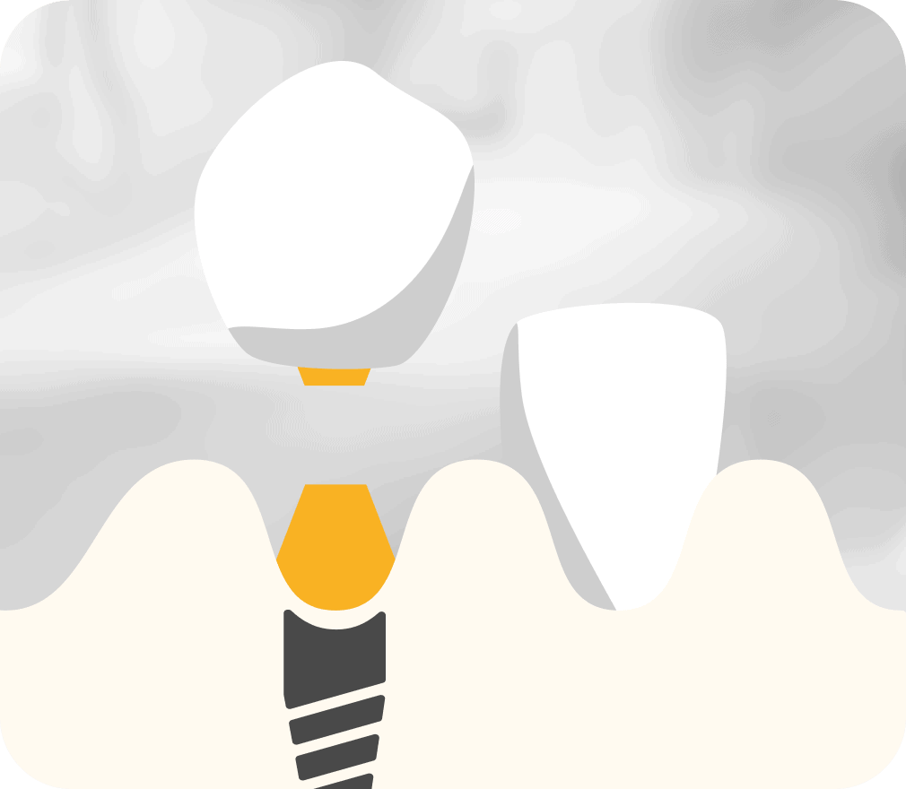 Zahnimplantat-Illustration mit Kieferknochen, Abutment und Krone, Darstellung des Aufbaus und der Platzierung.